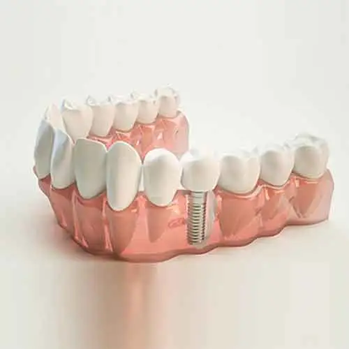 Implantes Dentales Dr Marques